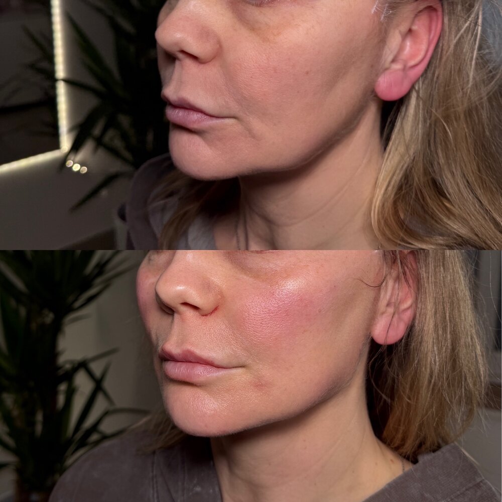 Modelowanie ust kwasem hialuronowym — efekt before / after, LOOK BETTER Kinga Rusin