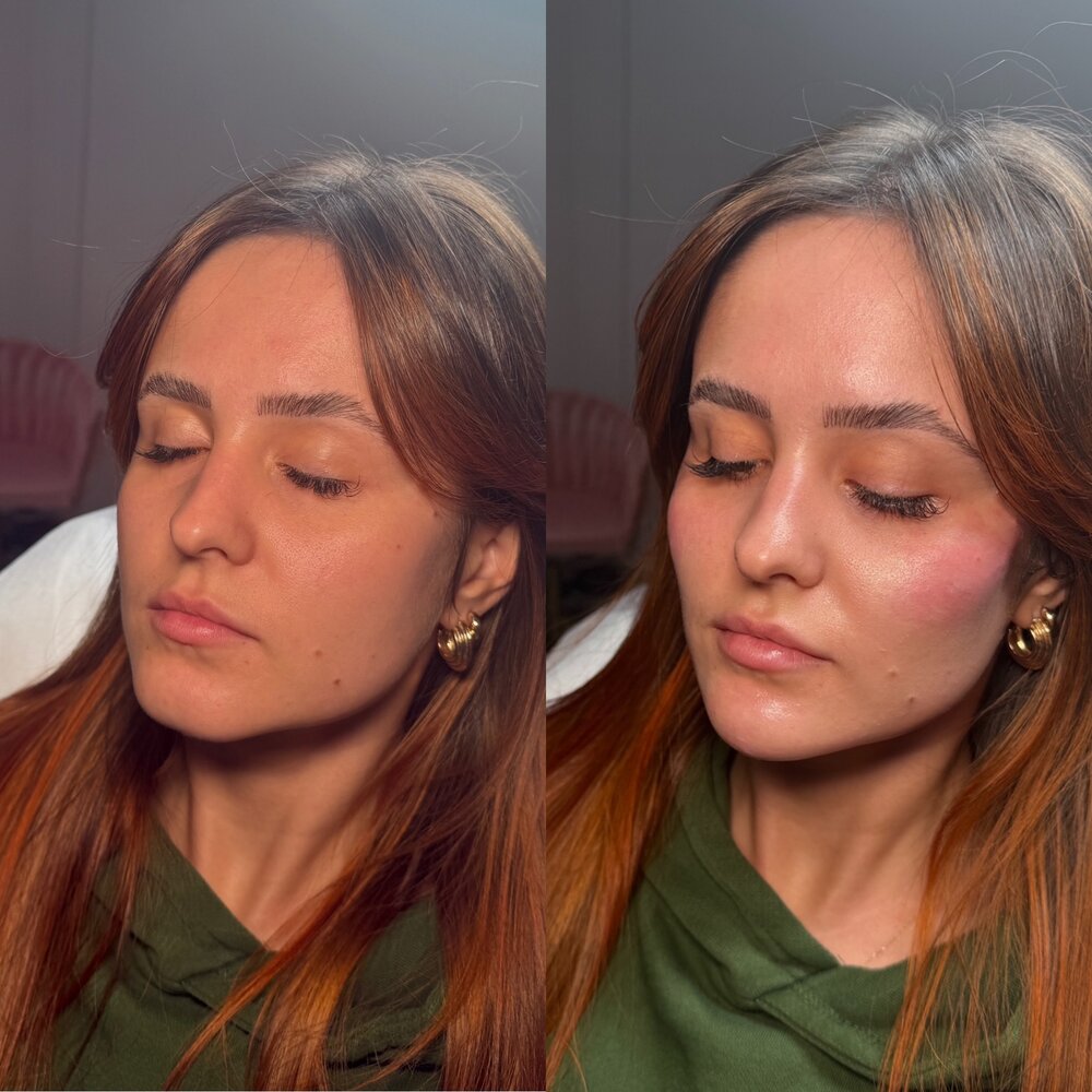 Metamorfoza twarzy — efekt zabiegu LOOK BETTER Kinga Rusin