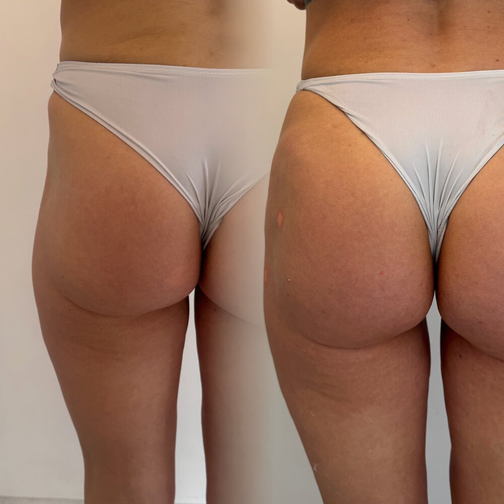 Modelowanie pośladków kwasem hialuronowym — efekt LOOK BETTER